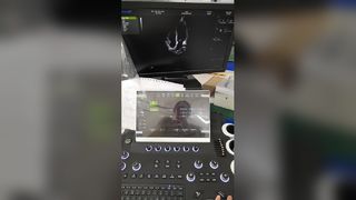 Sistema de diagnóstico por ultrasonido Doppler color con carro BR-US01